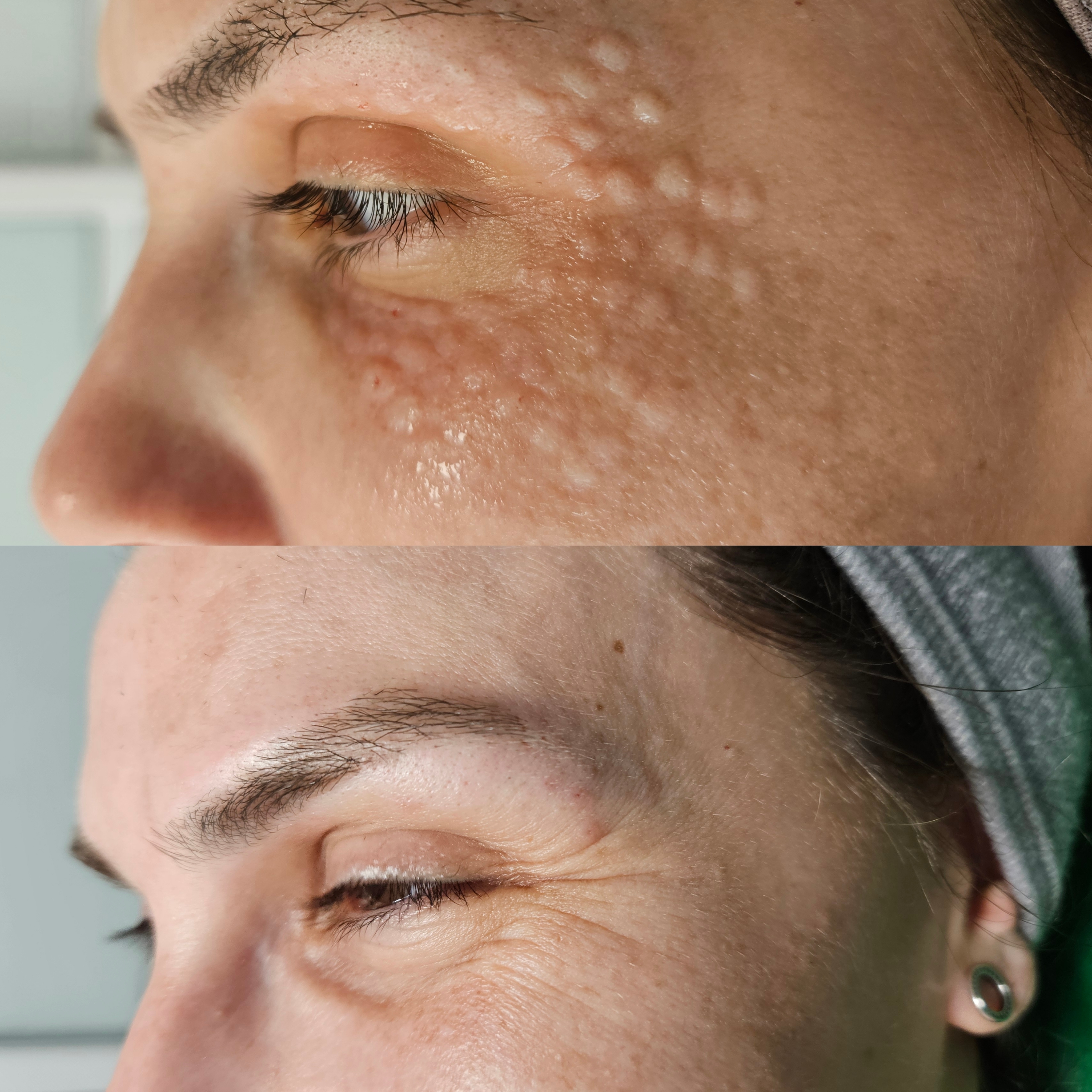 Eye mesotherapy