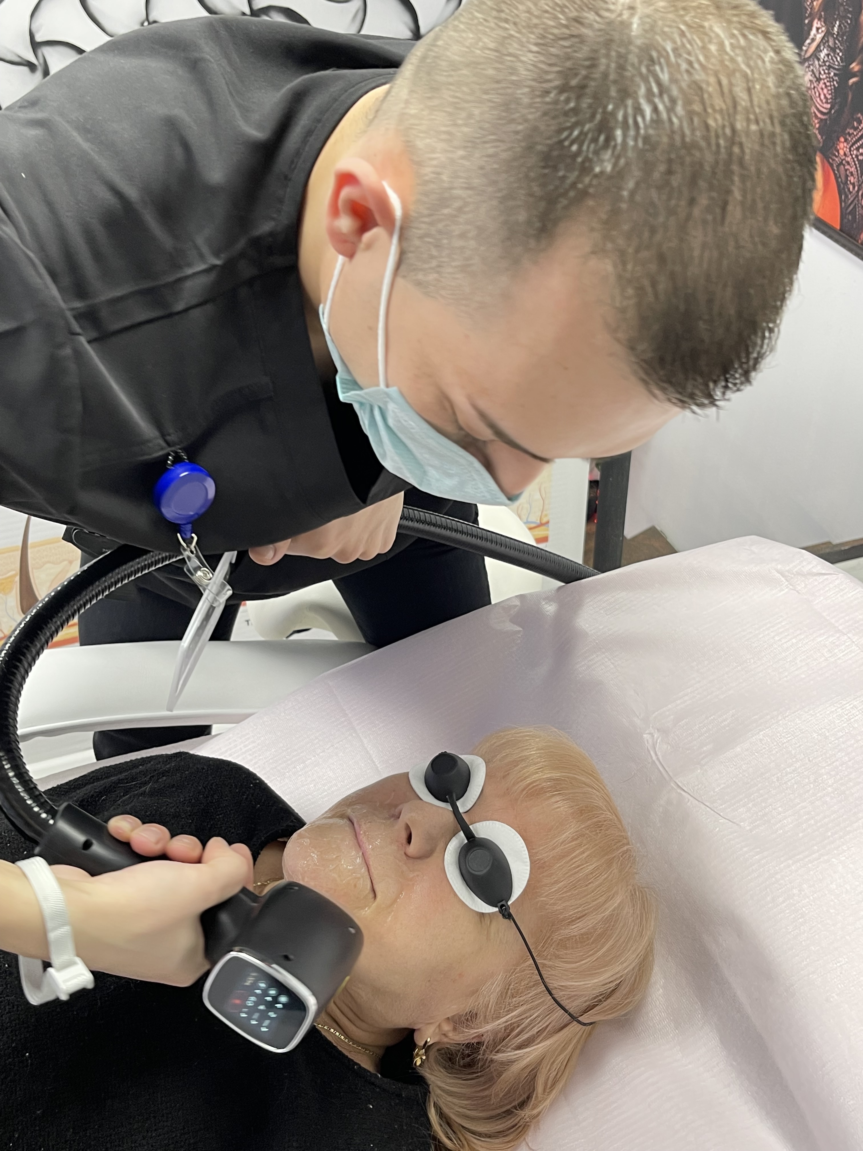 Upper Lip - laser hair removal / for women