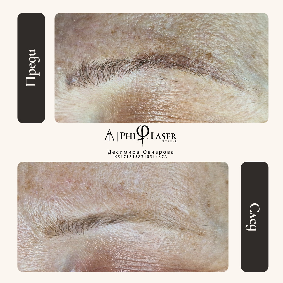 Result after removing microblading with just one