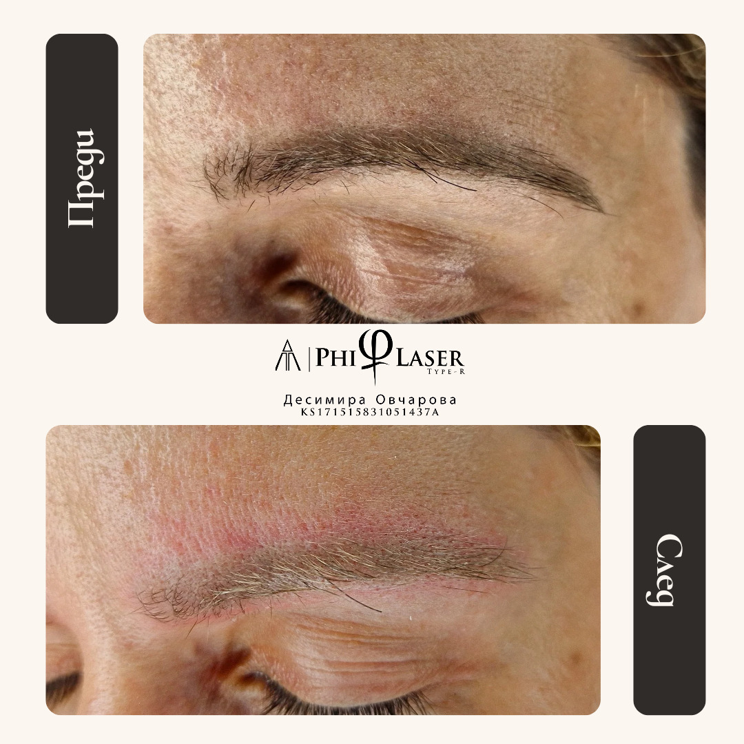 Result of micro-pigmentation removal after a