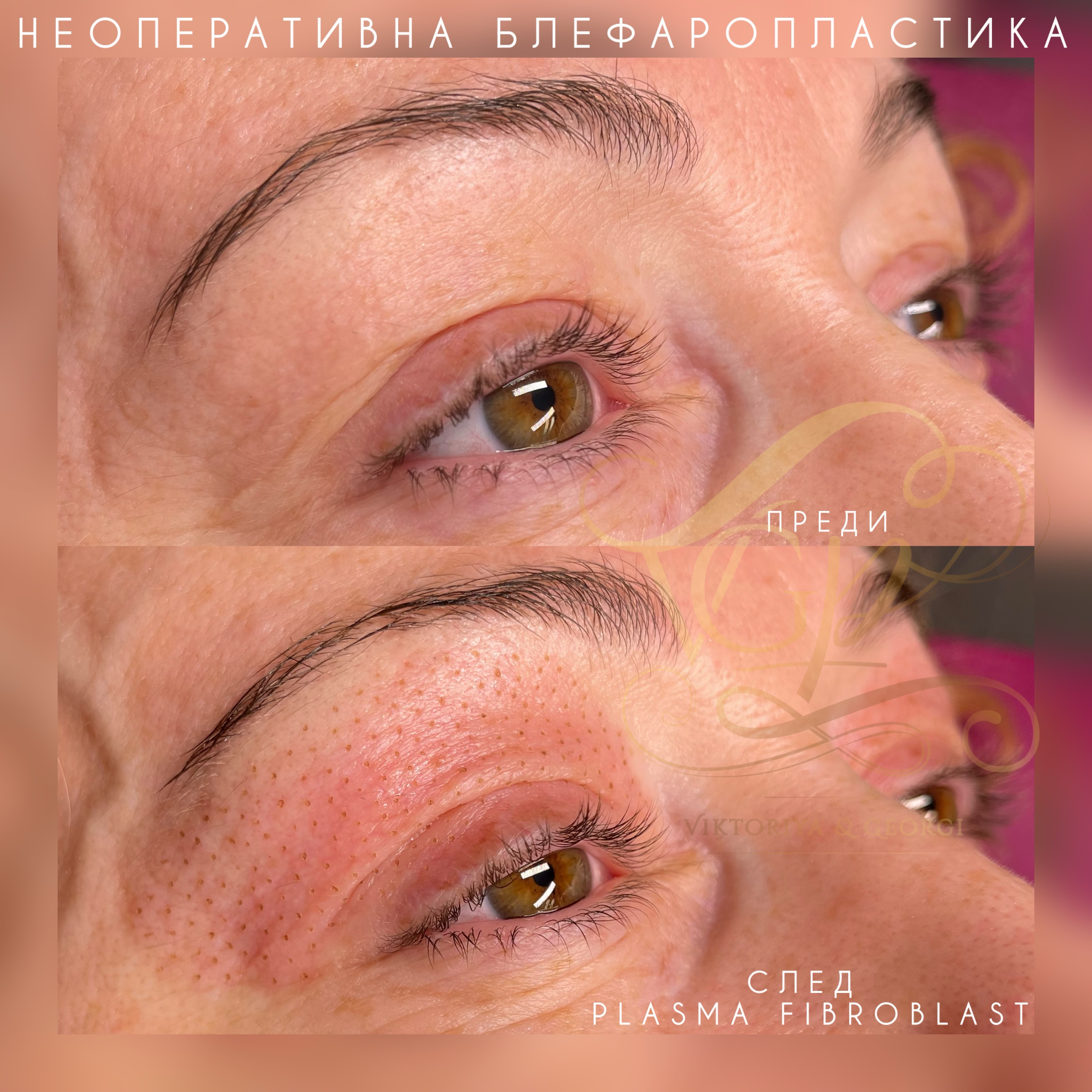 Droopy eyelid lift treatment