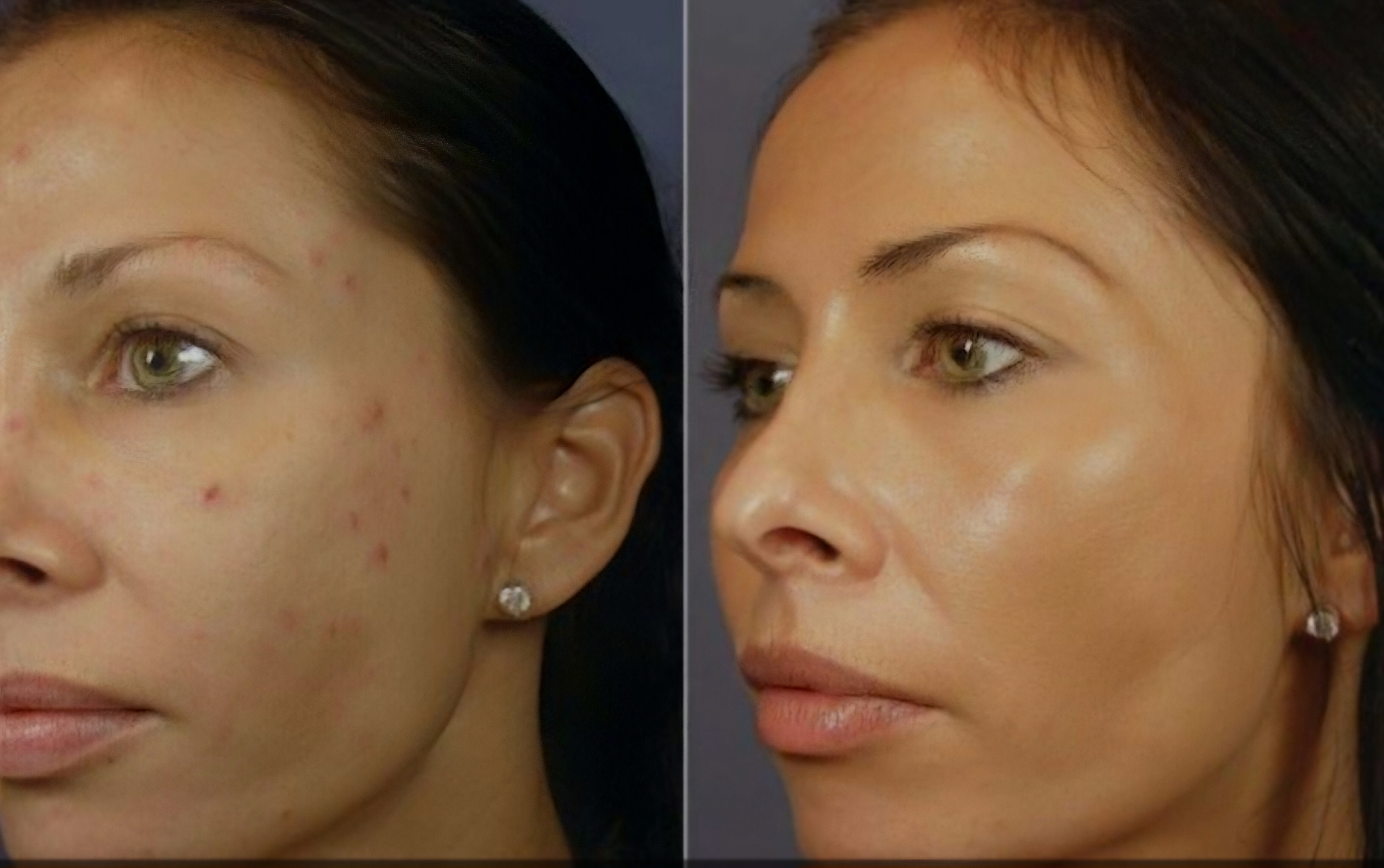 + Laser Carbon Peel